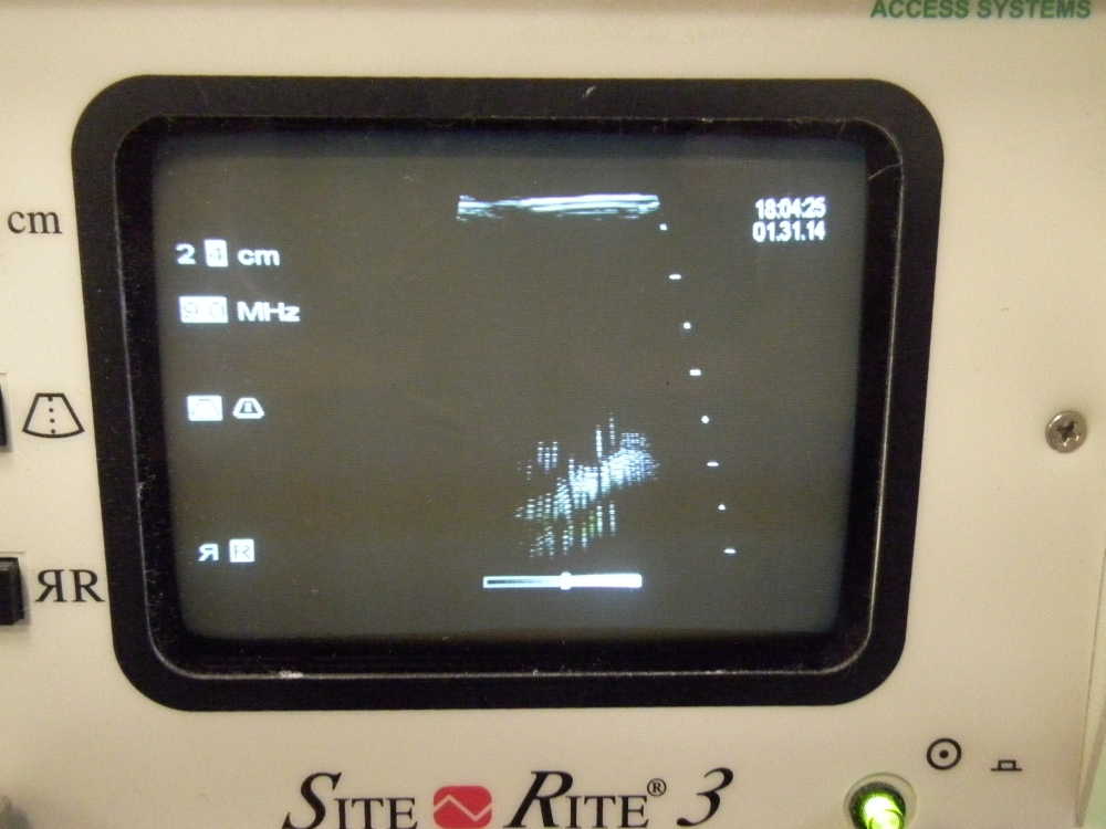 Bard Site Rite 3